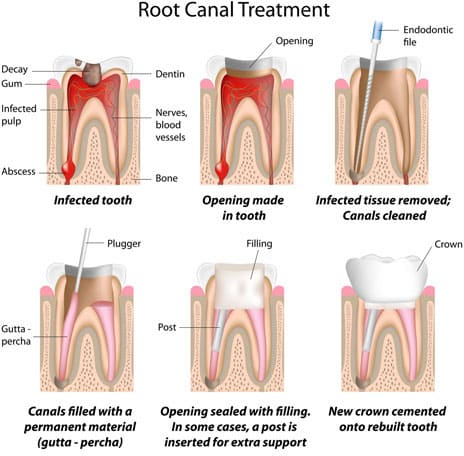  Root Canal Dental Treatment