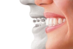 Invisalign vs Braces Comparison